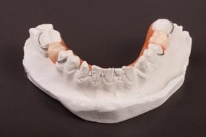 Partial denture on a dental mold