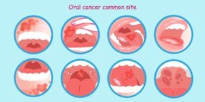 Diagram showing various oral cancer locations