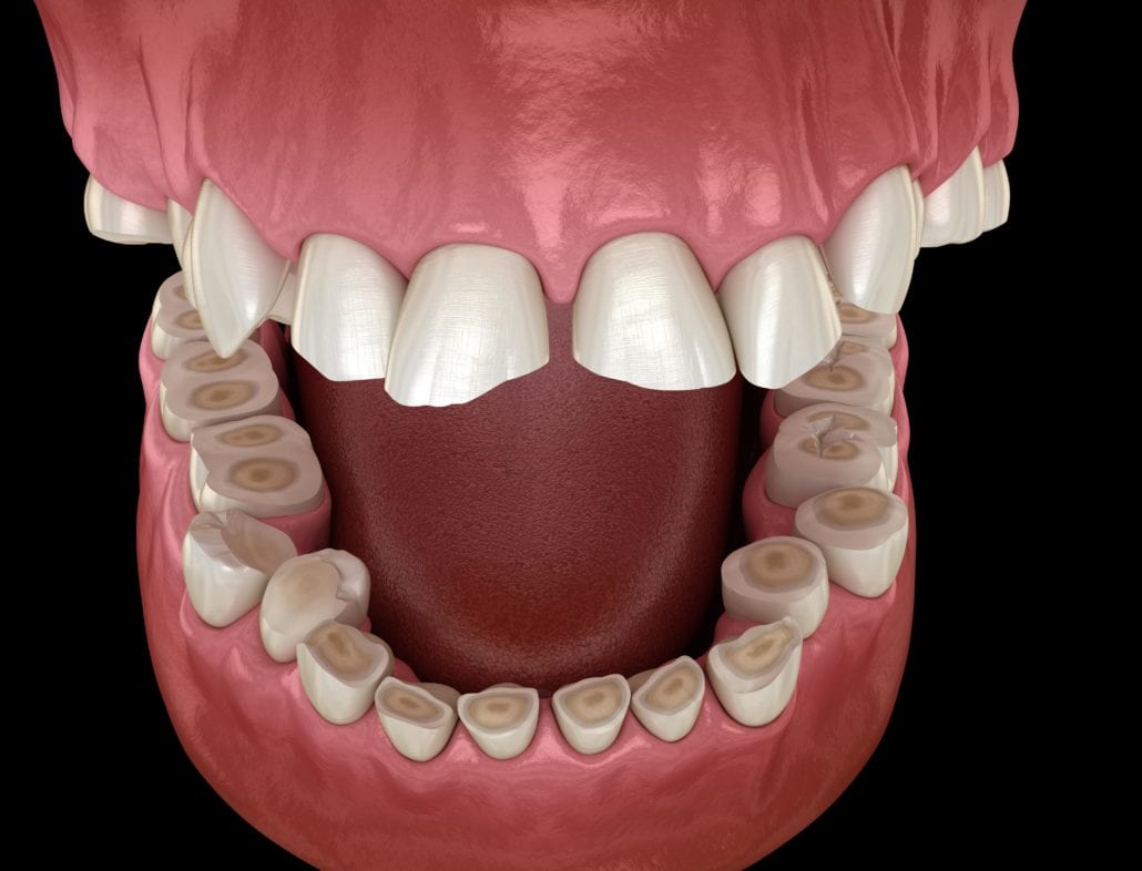 Teeth worn down by bruxism
